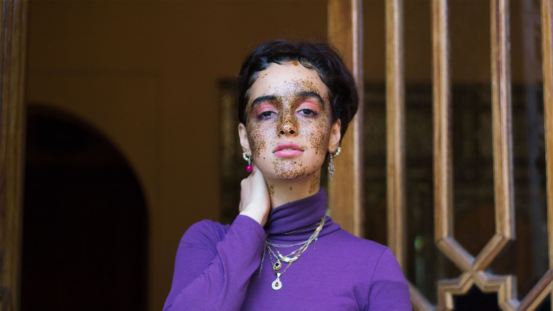Young woman with irregular dark freckles on her face