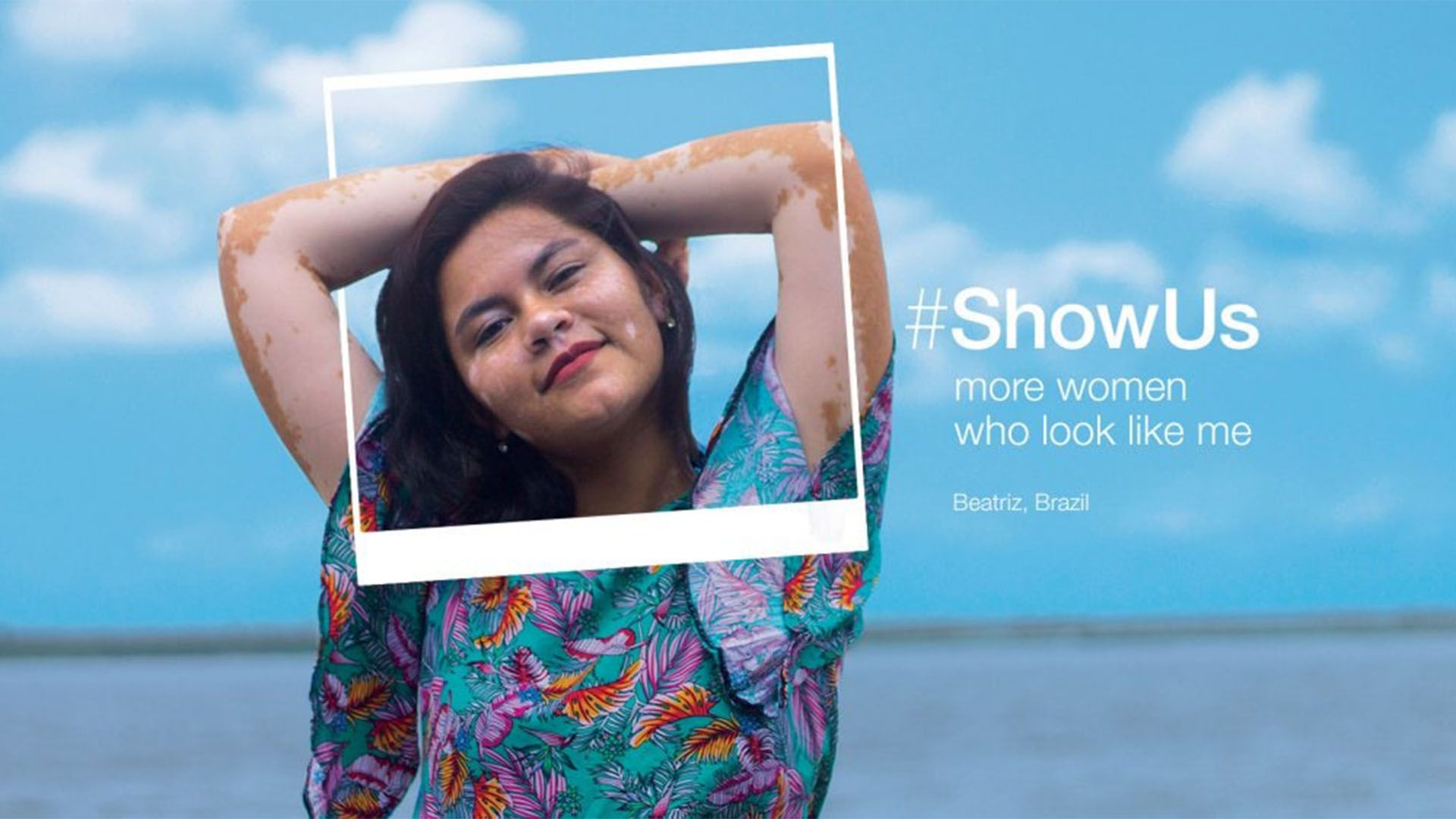 A smiling woman with scarred skin